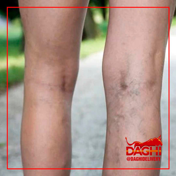 AL MENOS 50% DE LOS VENEZOLANOS TIENE INSUFICIENCIA VENOSA SUPERFICIAL