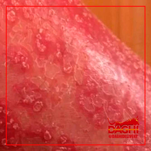 ¿QUÉ ES LA LEPRA? LA ENFERMEDAD BÍBLICA QUE PRESENTA CINCO CASOS EN MÉXICO